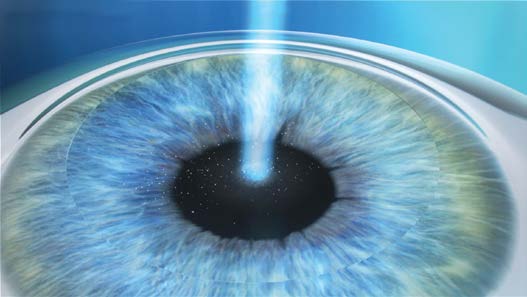 Étape 2 : Application du laser Excimer