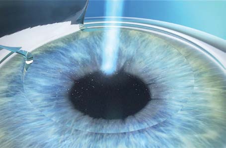 Étape 3 : correction de l’amétropie avec le laser excimère