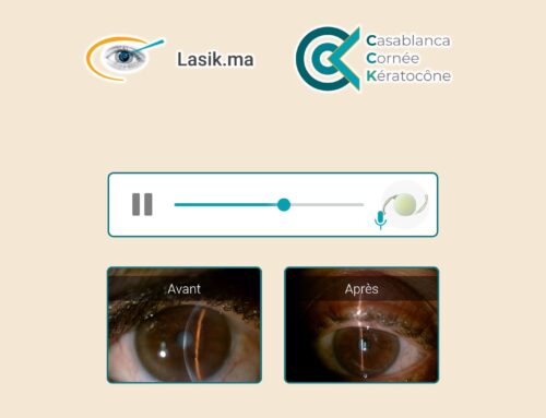 Témoignage audio 001 – Implant multifocal cataracte
